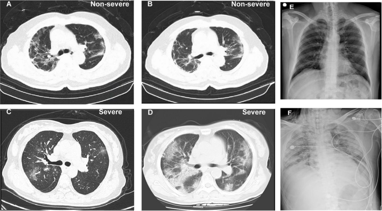 新冠肺炎肺部CT影像图